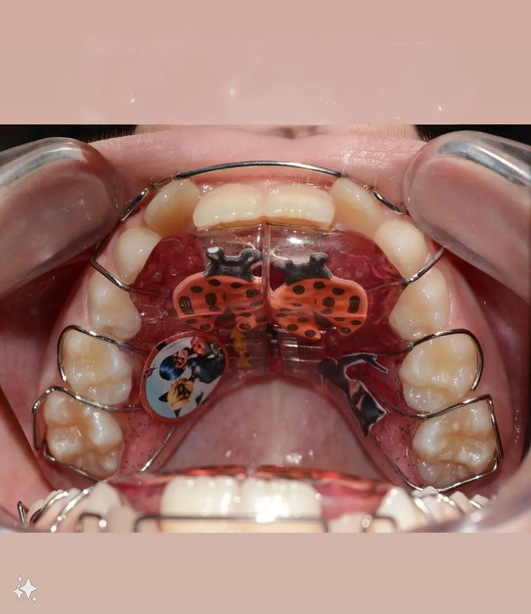Дитяча ортодонтія — ортодонт Пустомити