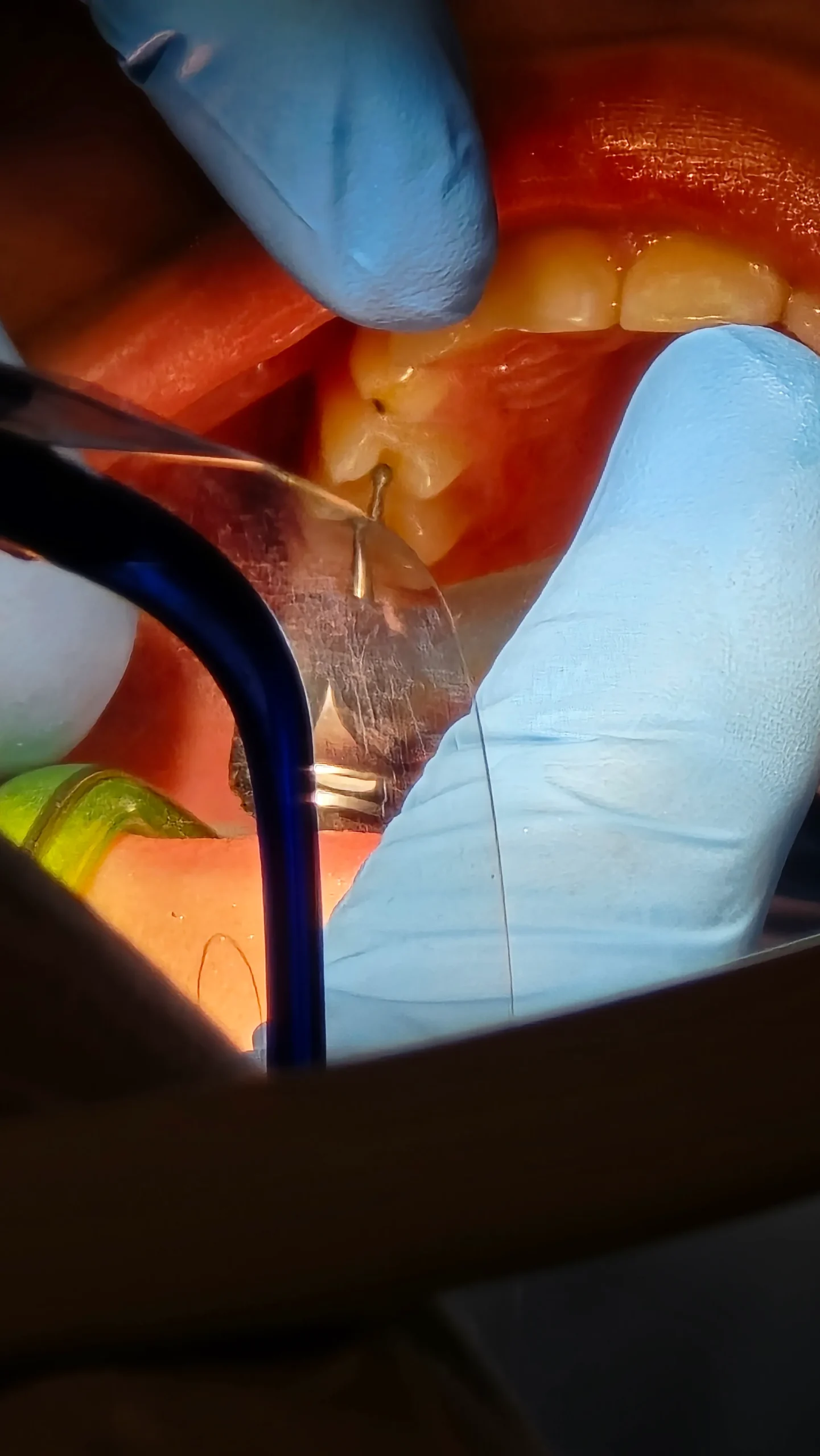 Художня реставрація після мікроскопа