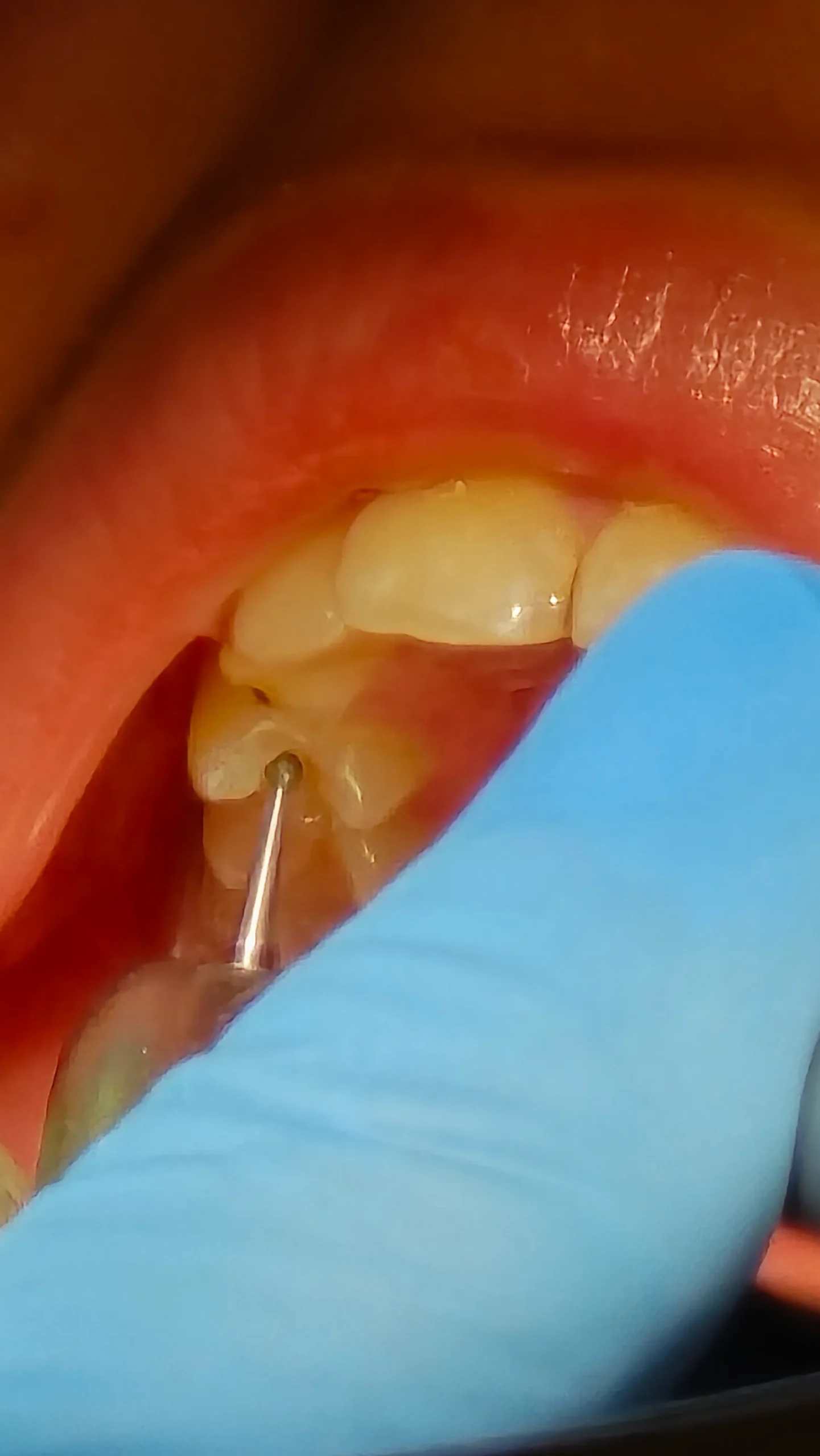 Ендодонтія під мікроскопом — результат