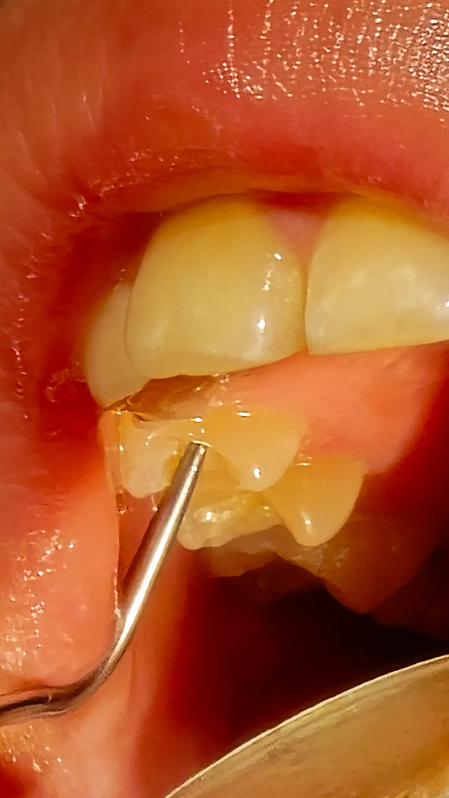 Лікування каналів під мікроскопом — Ваша Усмішка
