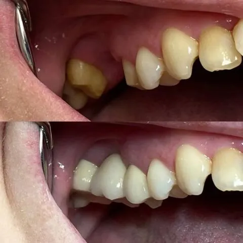 Вініри — результат роботи клініки Ваша Усмішка