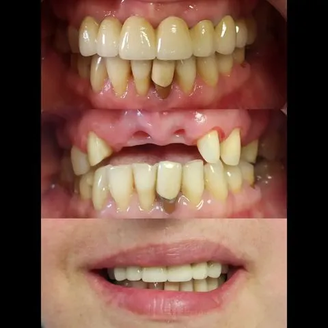 Цирконієві коронки — результат