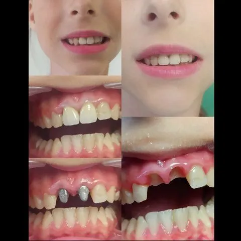 Естетичне протезування — результат