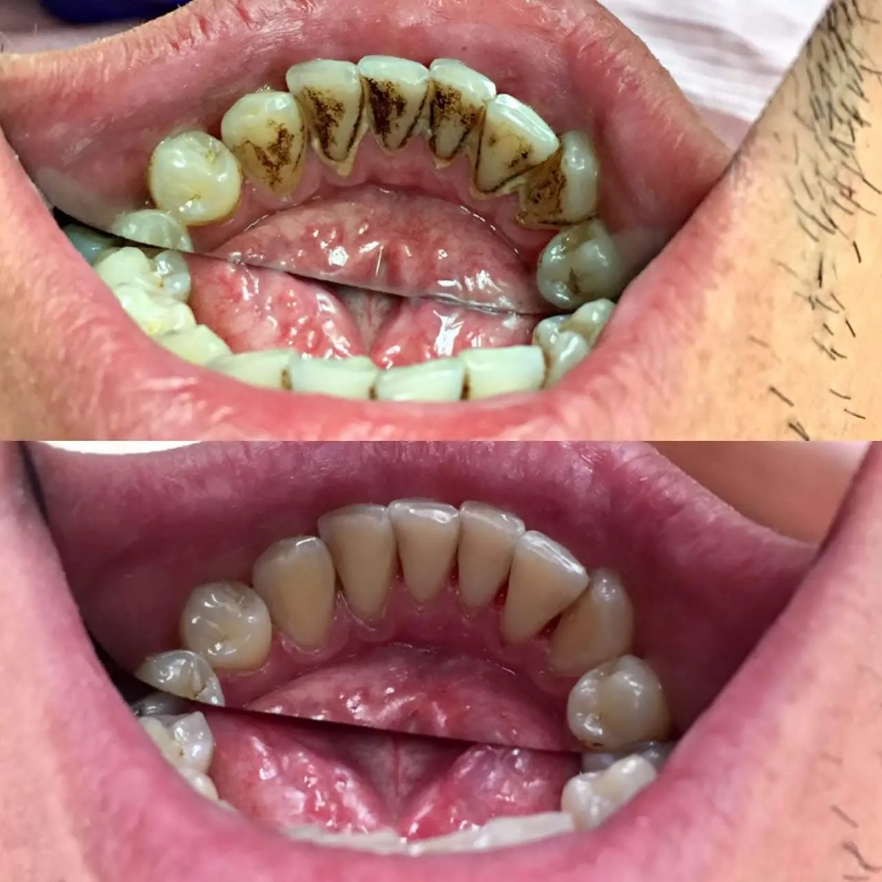 Відбілювання зубів — до і після