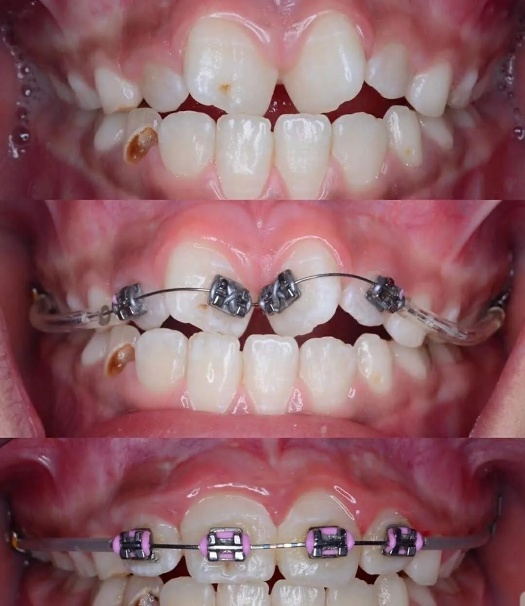 Ортодонтія — результат лікування брекетами