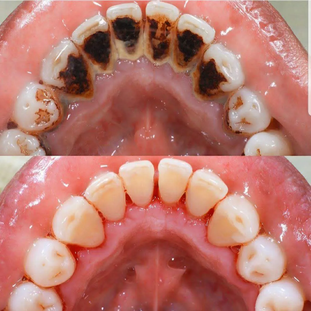 Гігієна зубів Air Flow — результат