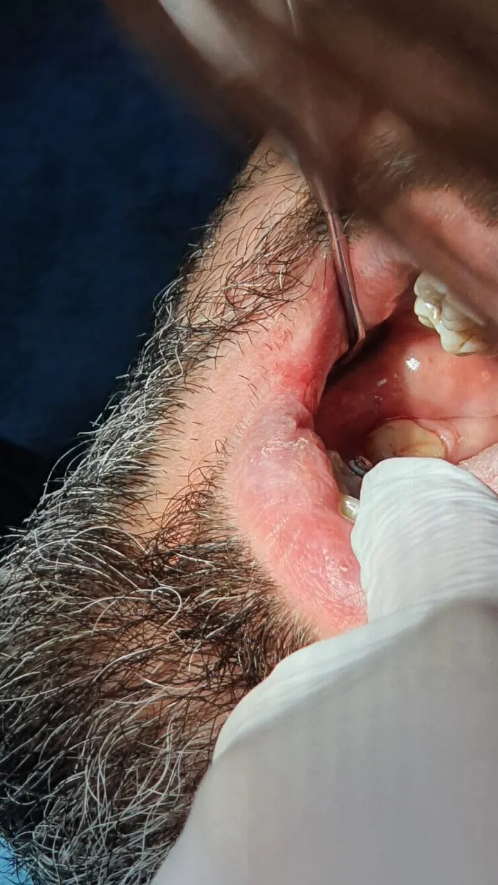 Osstem імплант до і після — клініка Ваша Усмішка