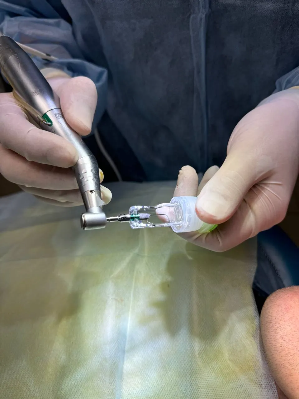 Імплантація зубів — результат клініки Ваша Усмішка