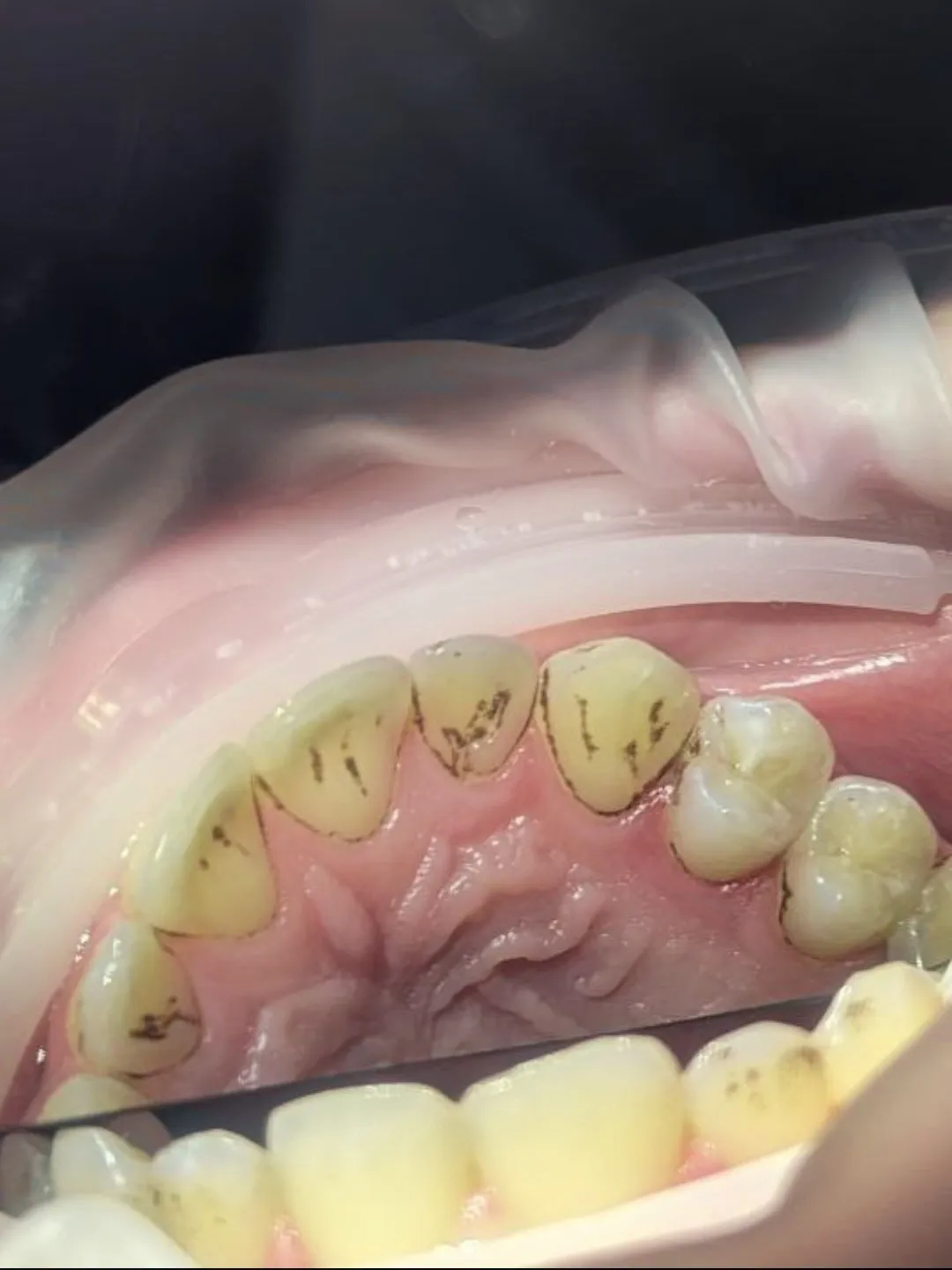 Зняття зубного каменю — результат